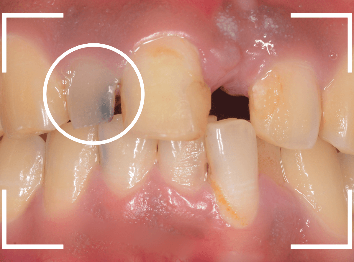 セラミック治療(前歯・クラウン)4-2