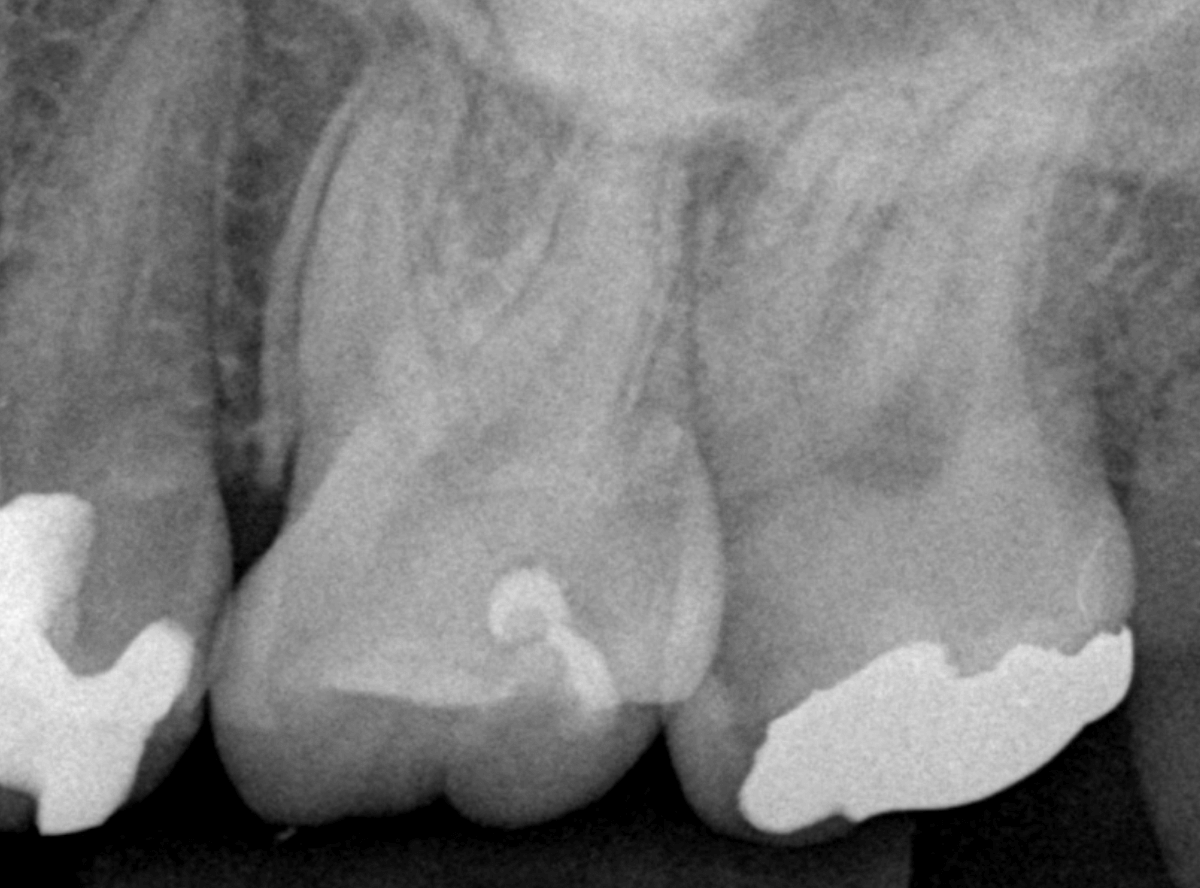 つめものの下の深い虫歯(画像)7-2