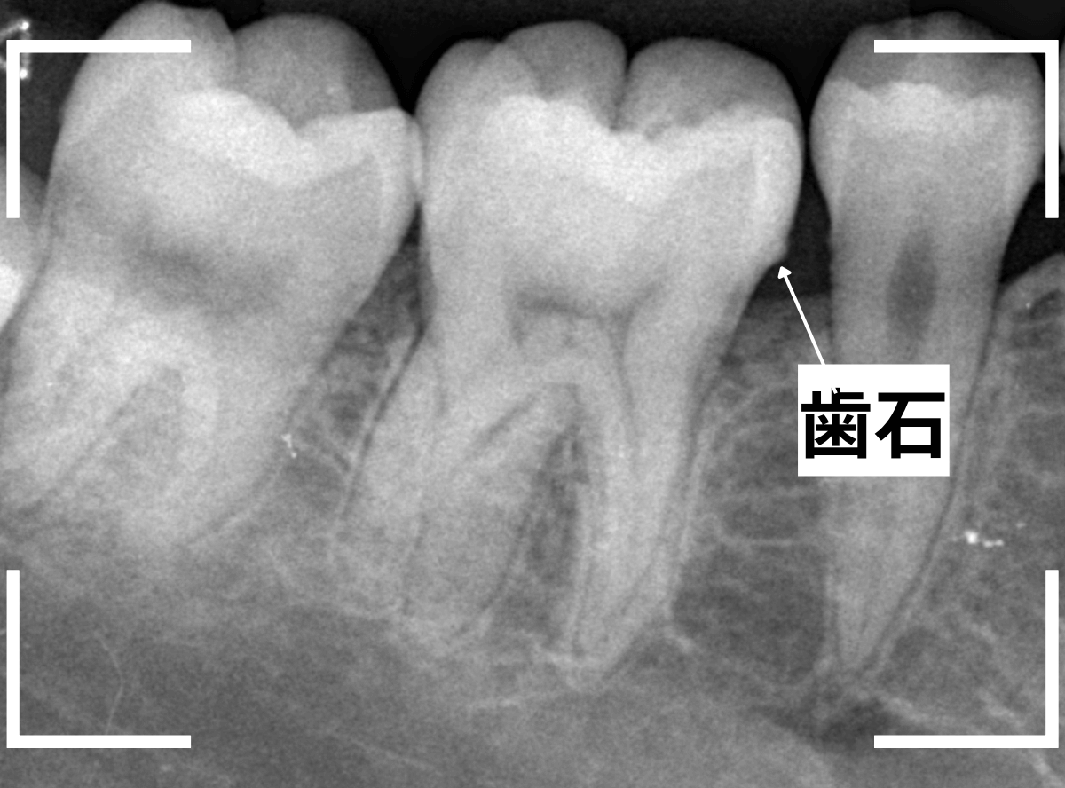レントゲンでわかりづらい虫歯4-2