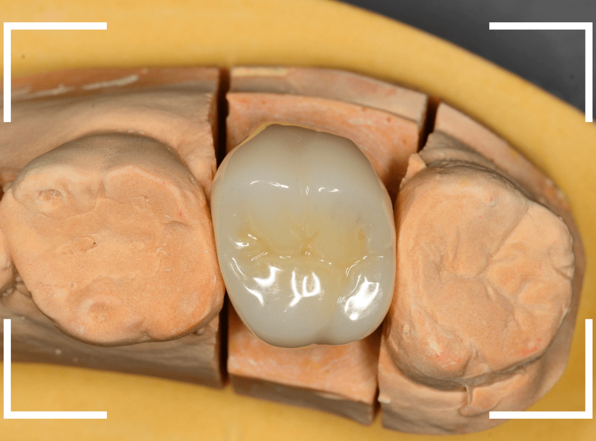 メタル・フリー治療の実際21-4