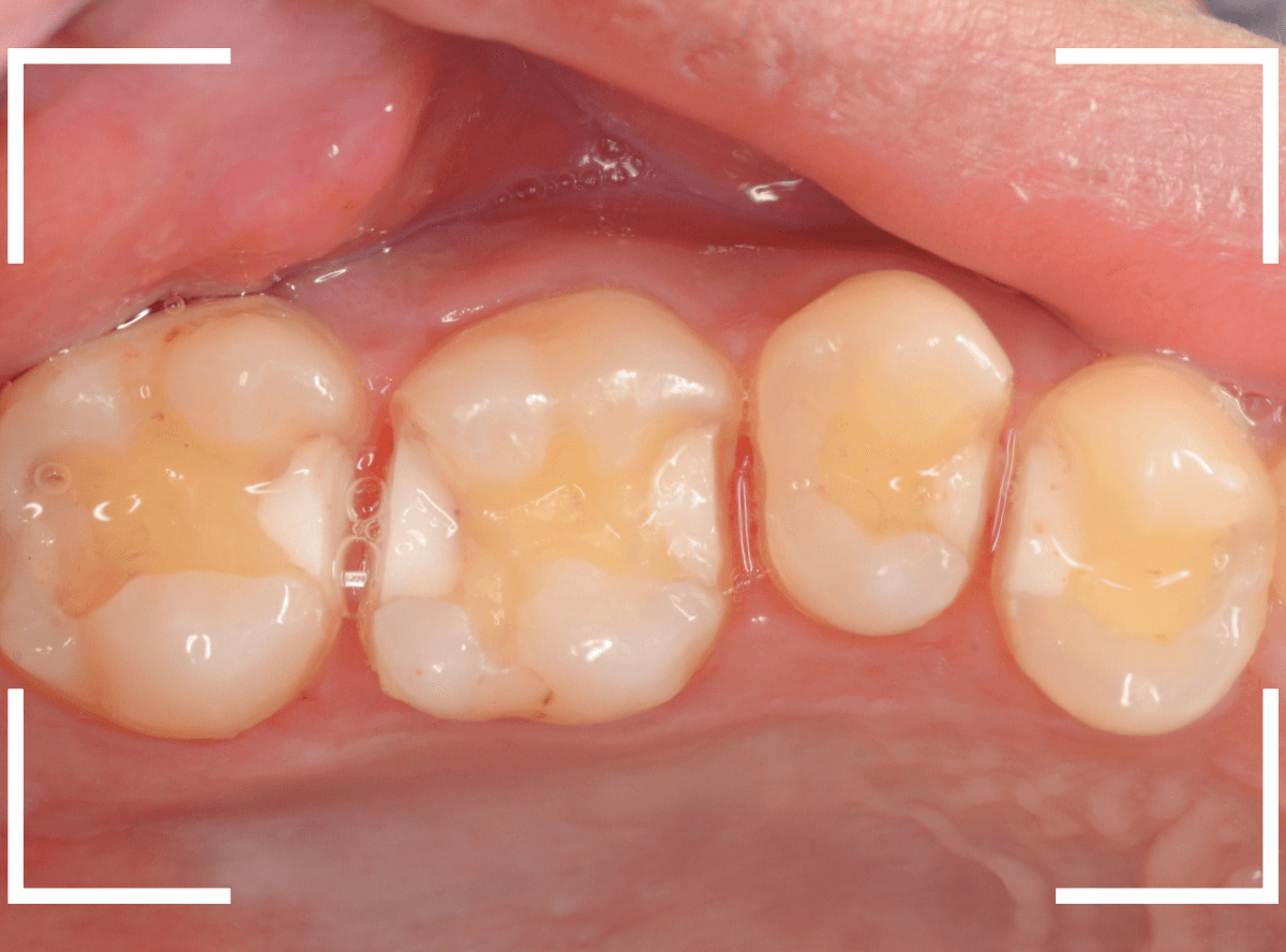 セラミック治療(インレー)34-2