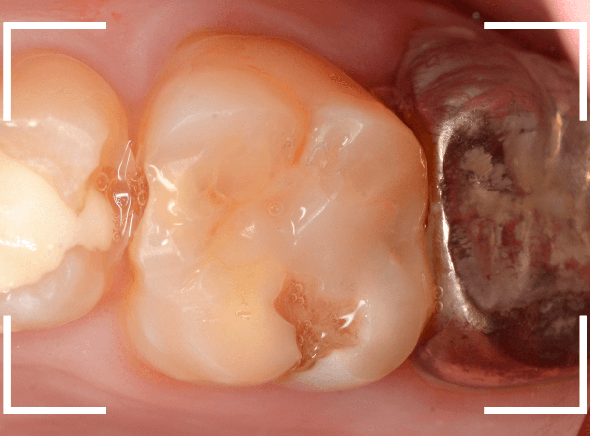 つめものの下の深い深い虫歯20-1