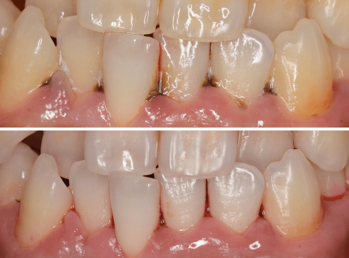 歯肉の中の歯石（歯肉縁下歯石）除去(画像）4-5