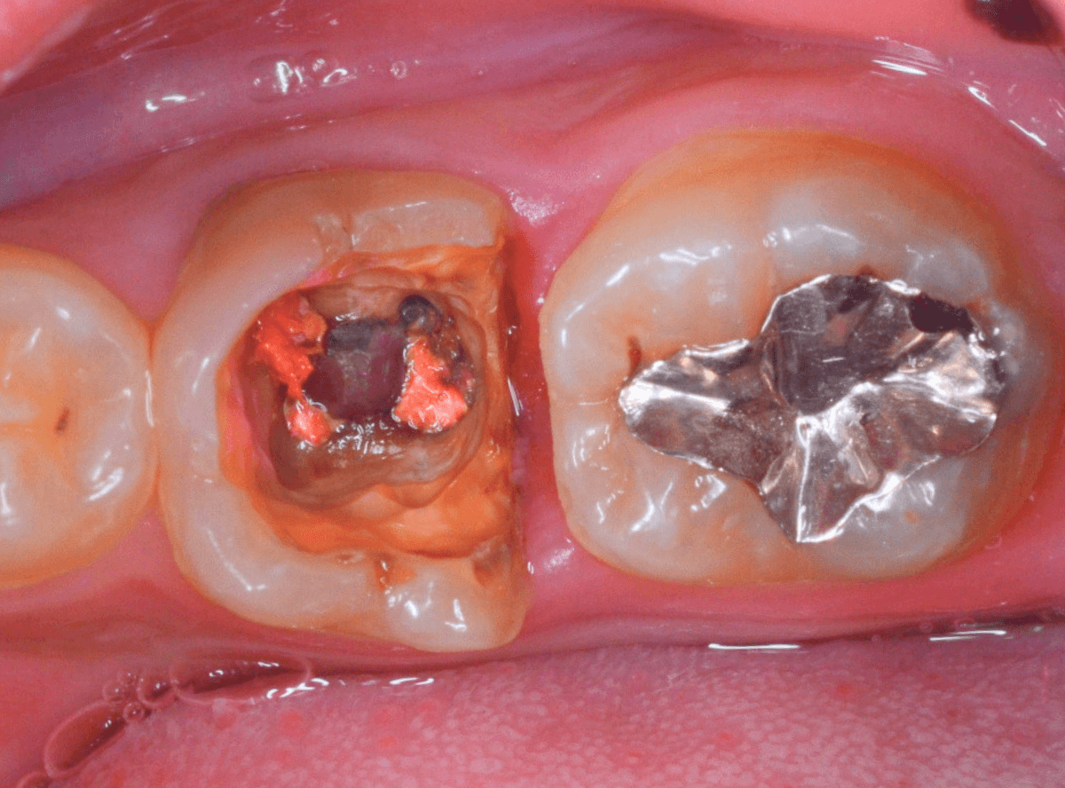 つめものが取れた歯の治療の画像-5