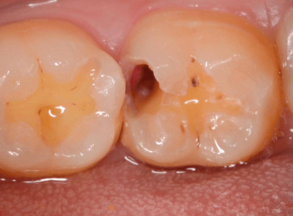 レントゲンでわかりづらい虫歯3-4