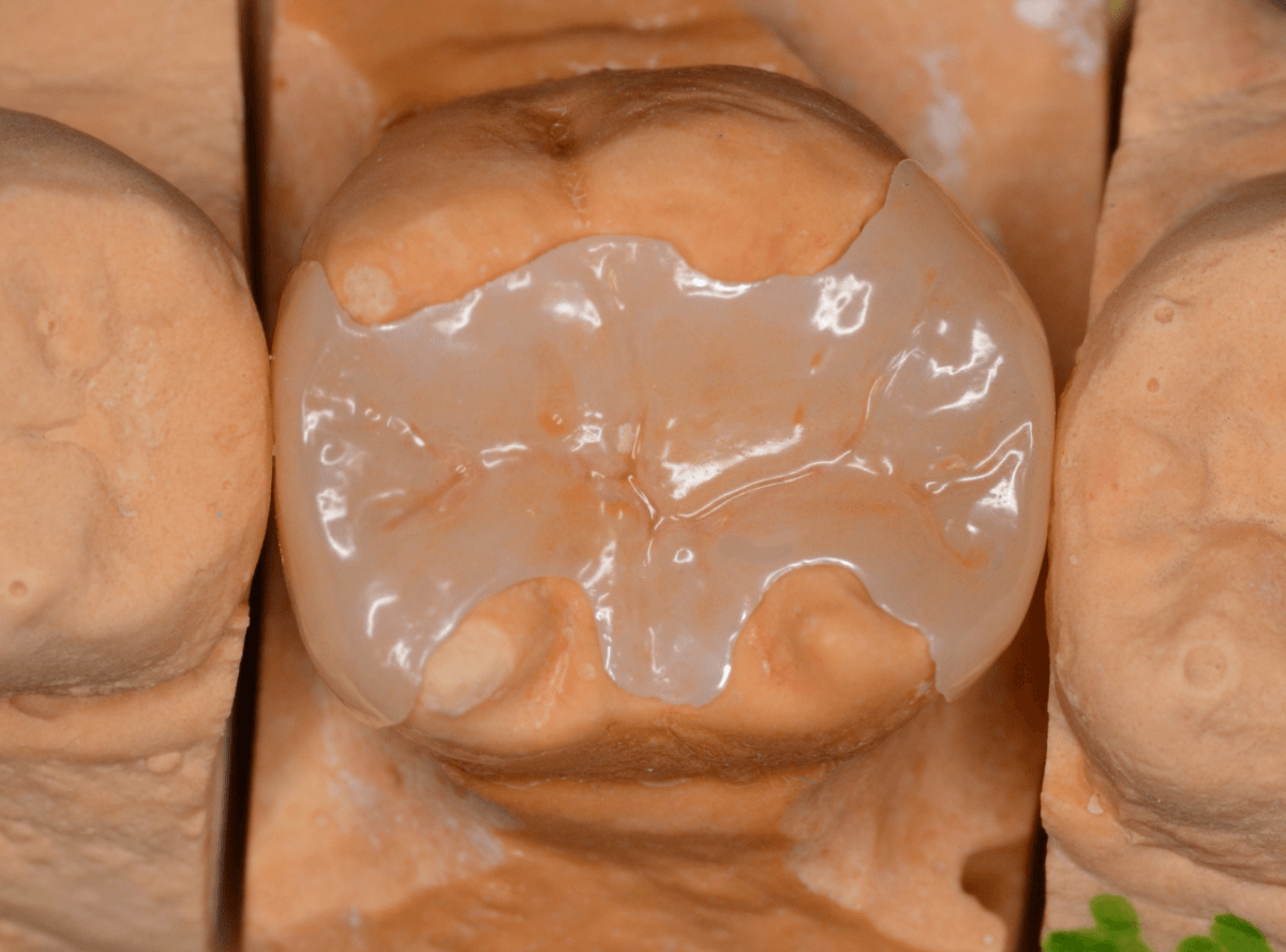 セラミック治療(インレー)10-2