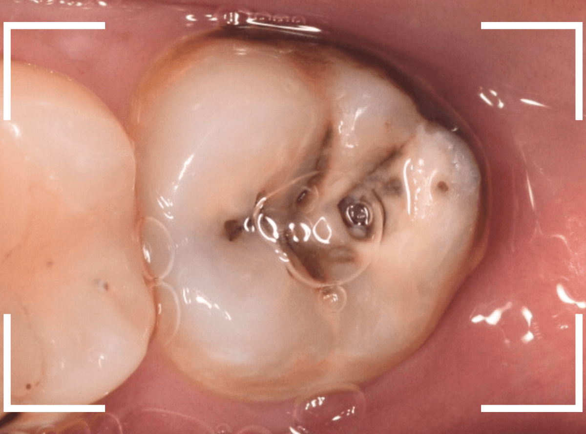 おやしらずの抜歯18-1