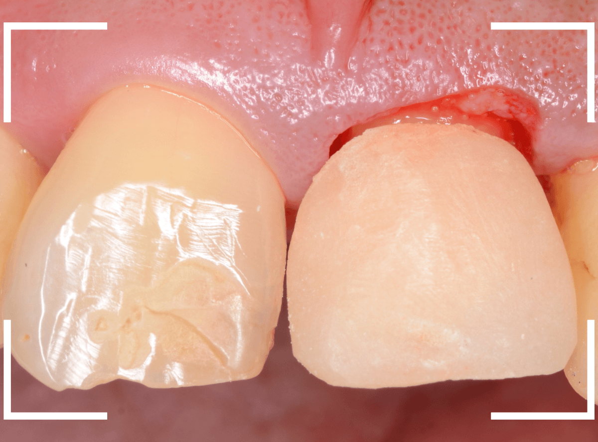 セラミック治療(前歯・クラウン)5-7