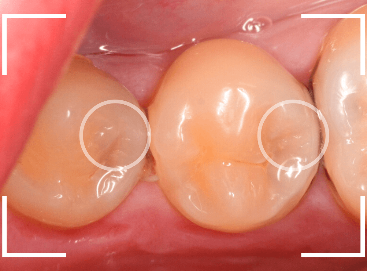 歯と歯の間の虫歯13-2