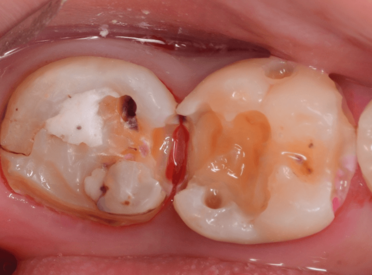 つめものの下の深い深い虫歯11-1