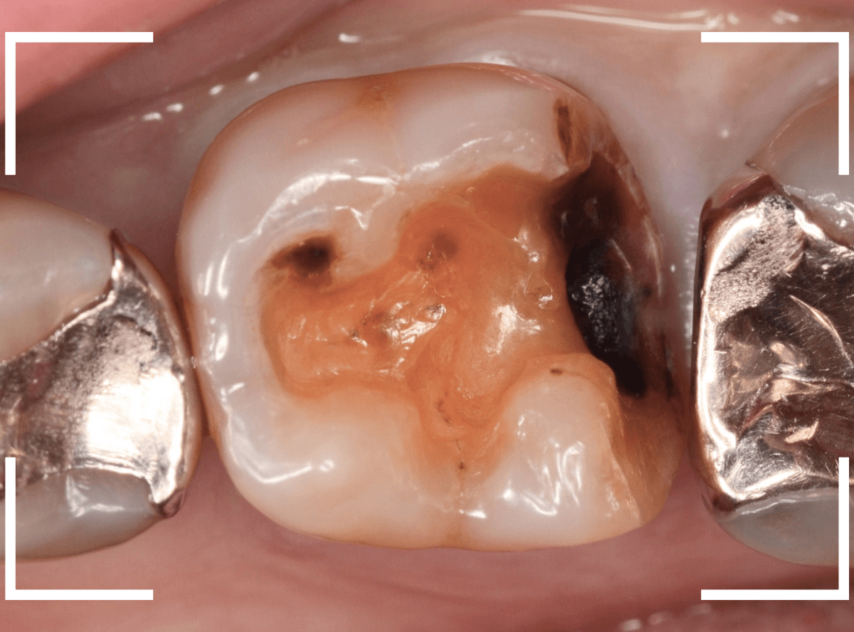 セラミック治療(インレー)17-1