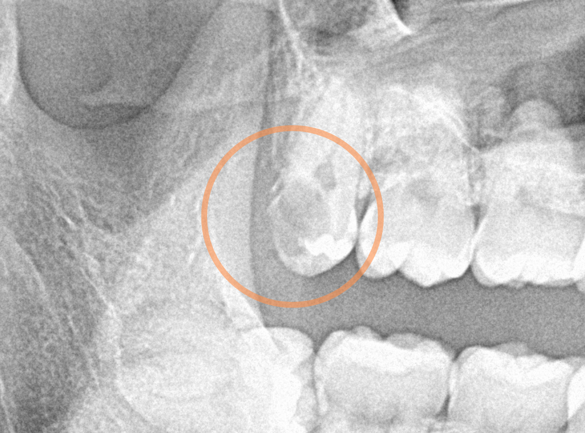 おやしらずの抜歯5-1
