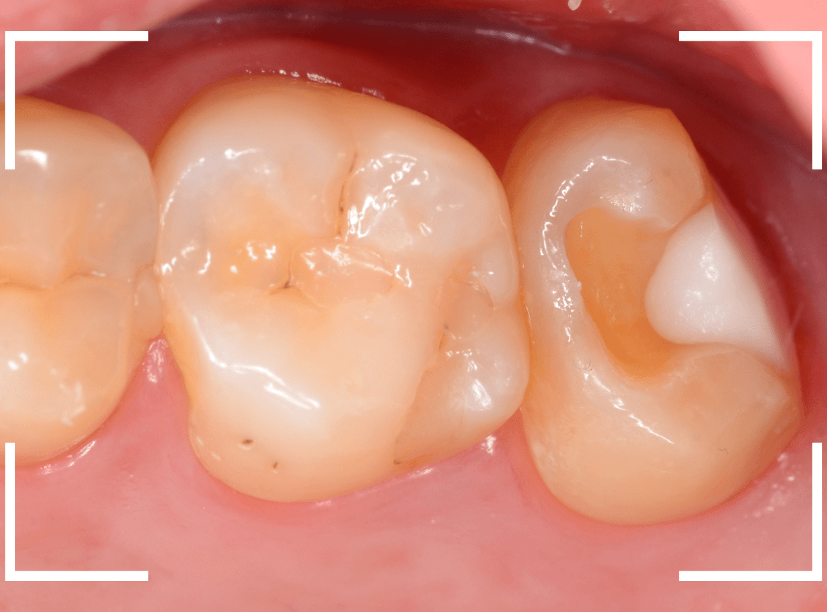 気づかないうちに深い虫歯5-5