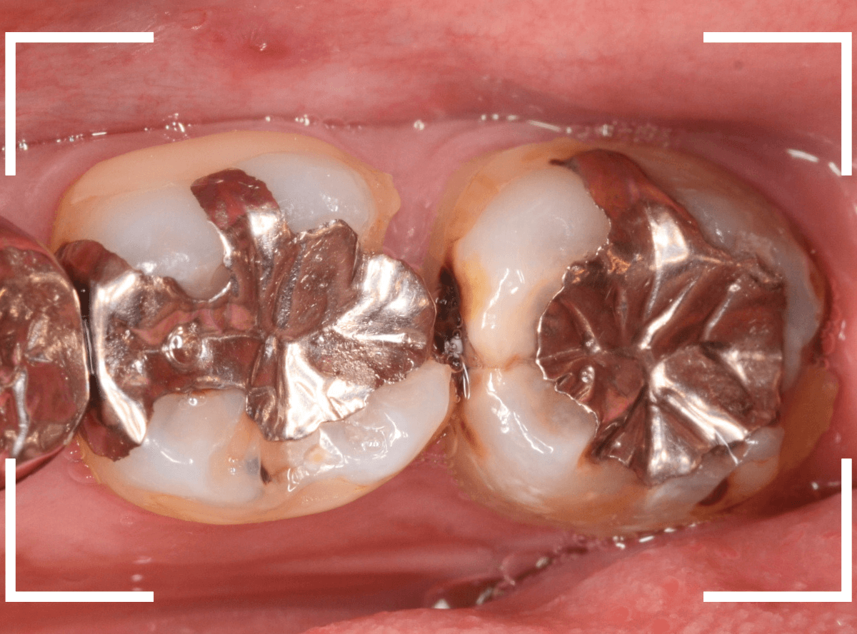 つめものの下の深い虫歯(画像)10-1