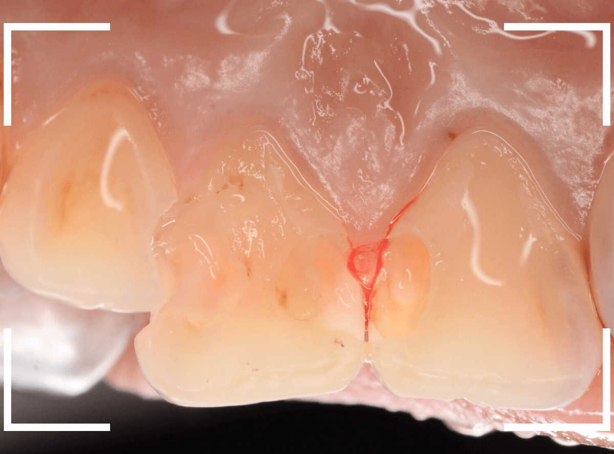 コンポジットレジン治療6-5