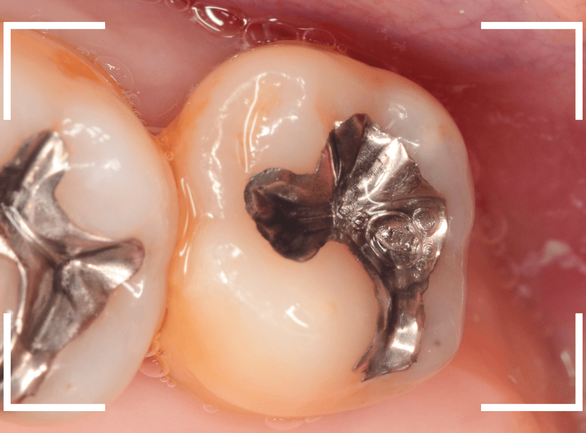 気づかないうちに深い虫歯18-3