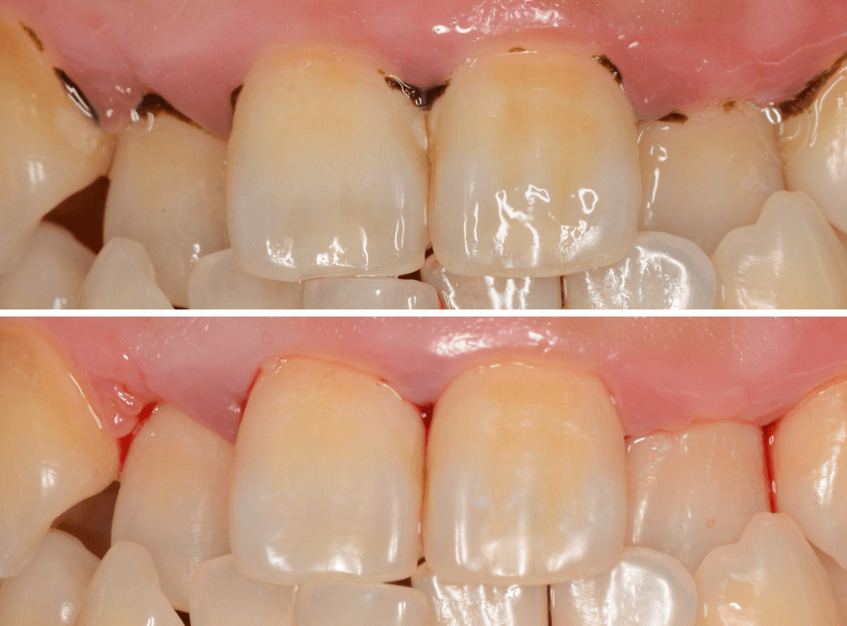 歯肉の中の歯石（歯肉縁下歯石）除去(画像）4-5