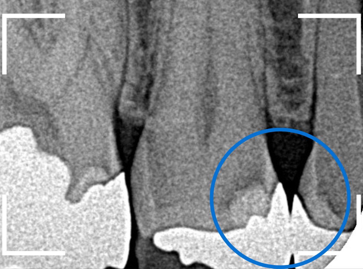 つめものの下の深い虫歯(画像)10-1