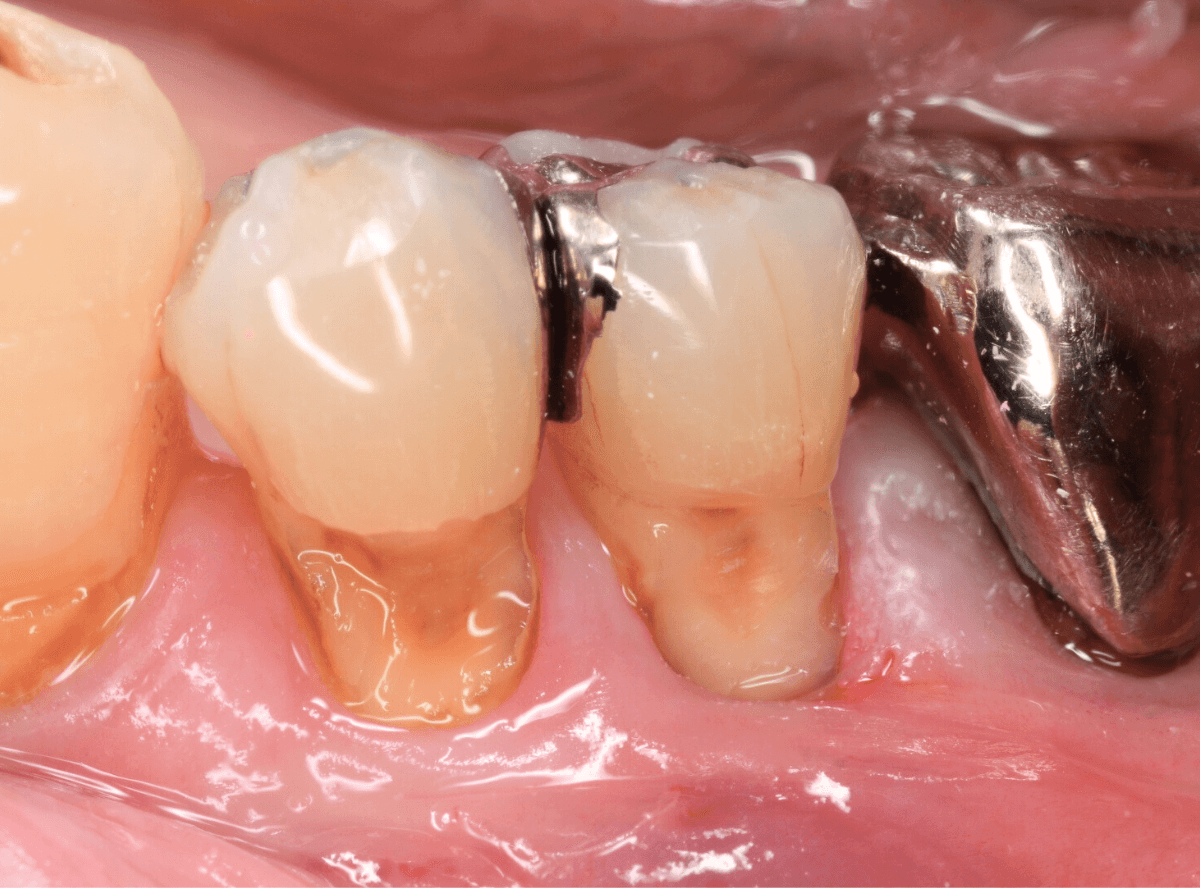 コンポジットレジン治療4-2