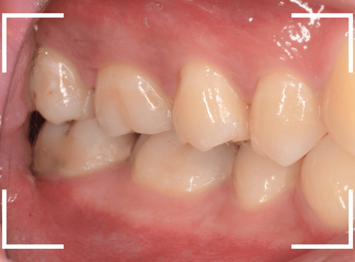 セラミック治療(インレー)34-6