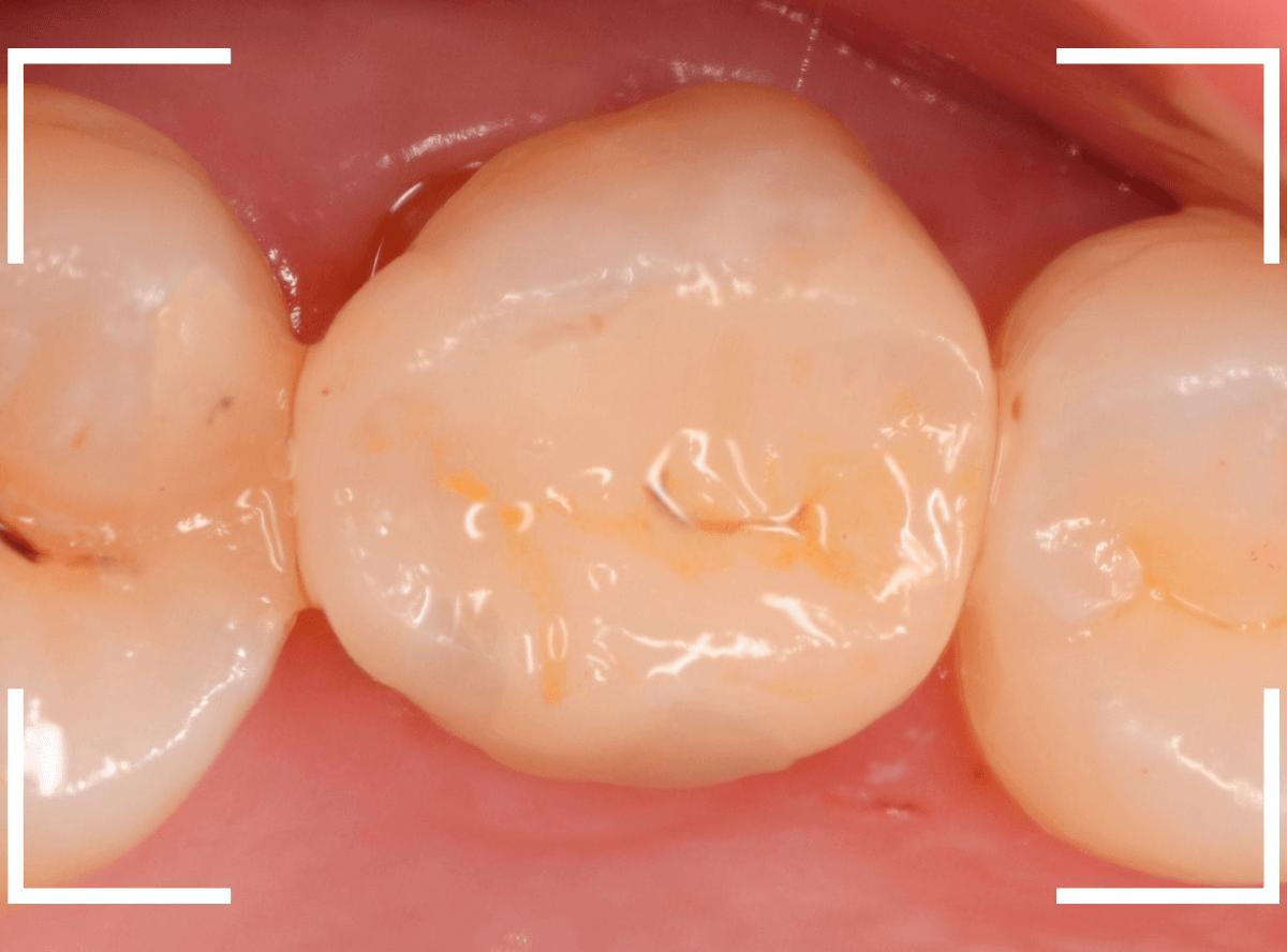 セラミック治療(インレー)35-4