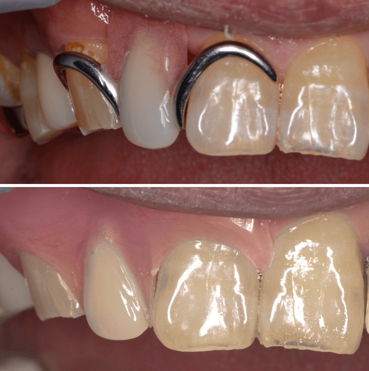 ノンクラスプ・デンチャー画像-5