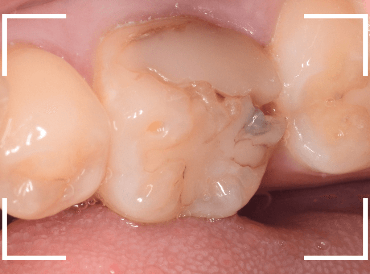 つめものの下の深い深い虫歯11-1