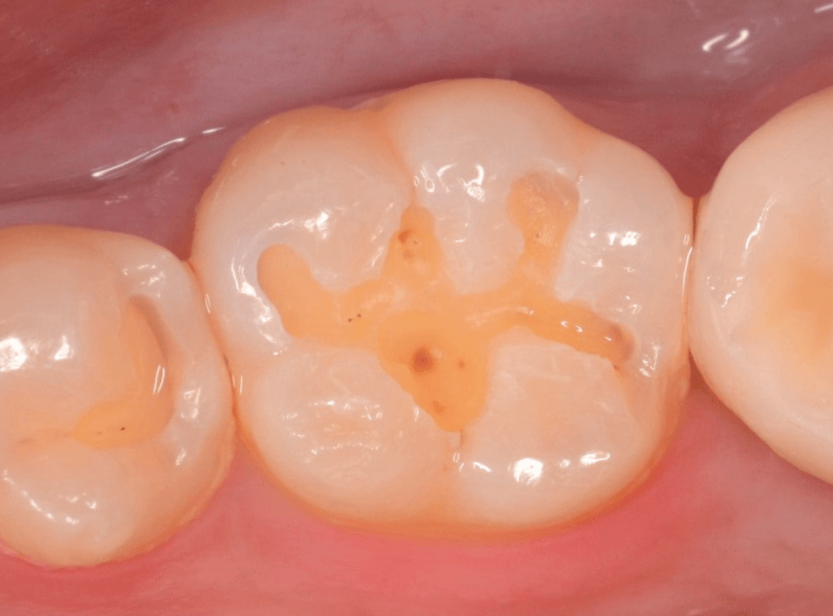 コンポジットレジン治療1-2
