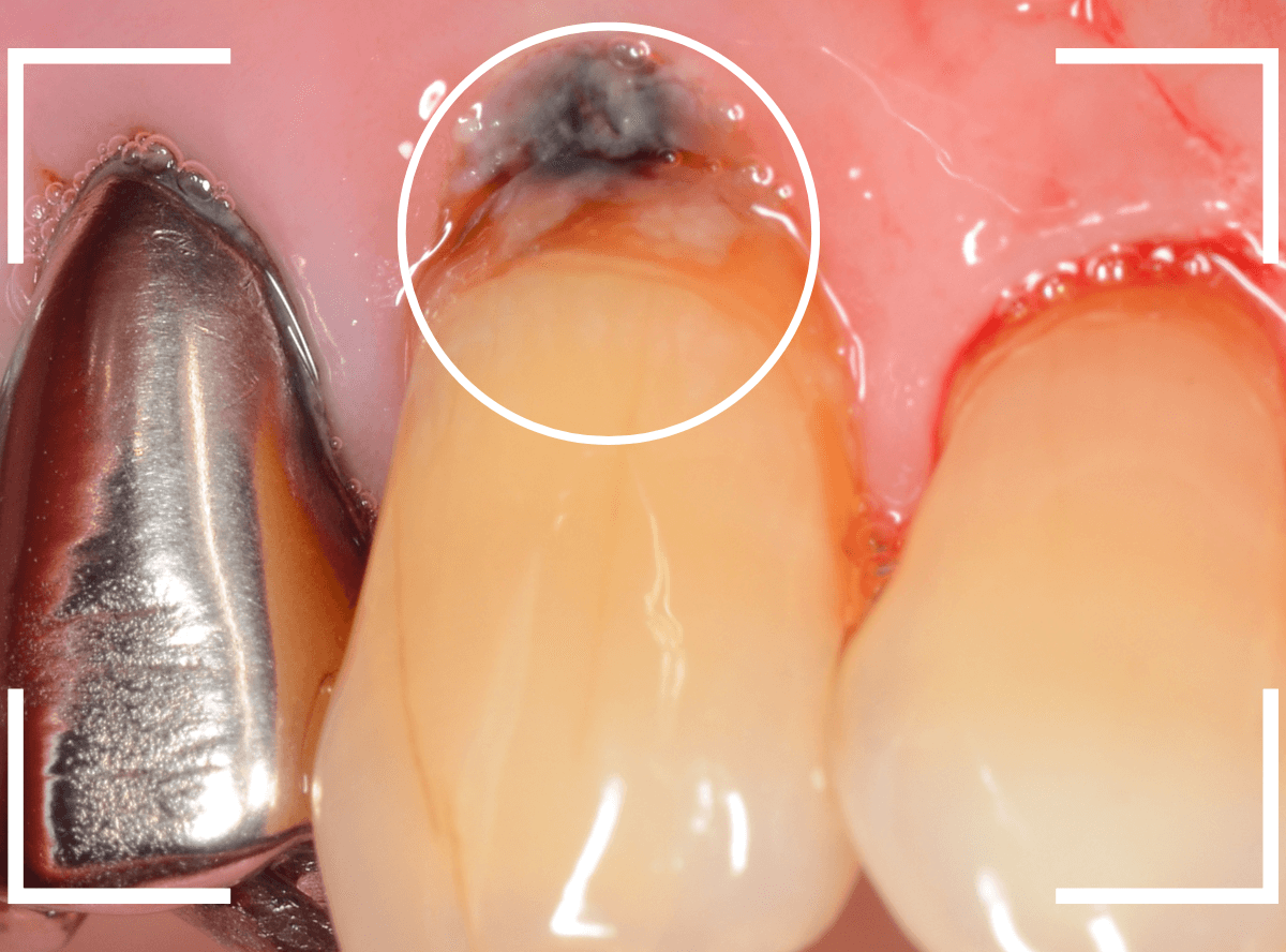 コンポジットレジン治療8-1