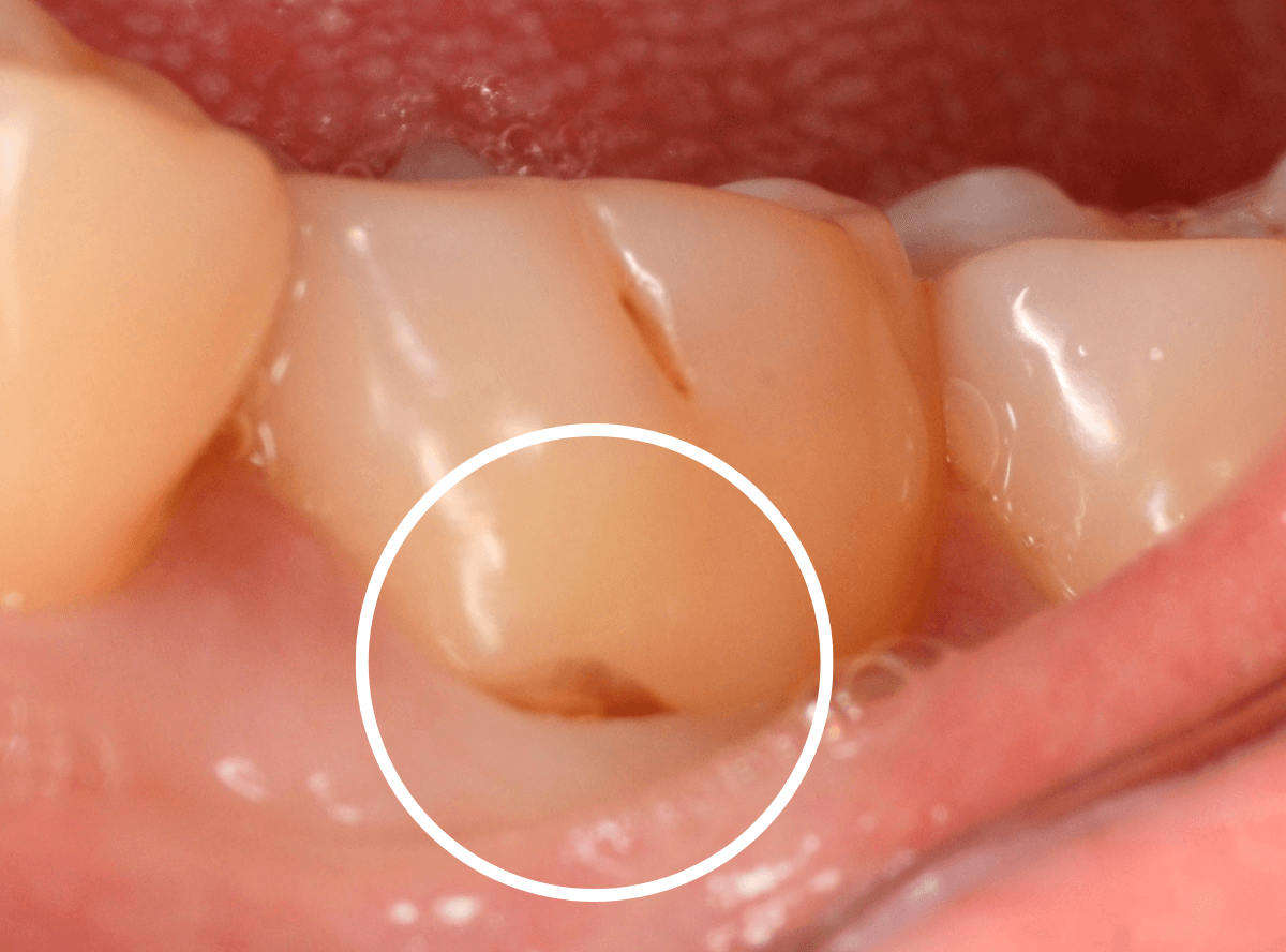 知覚過敏の画像5-2