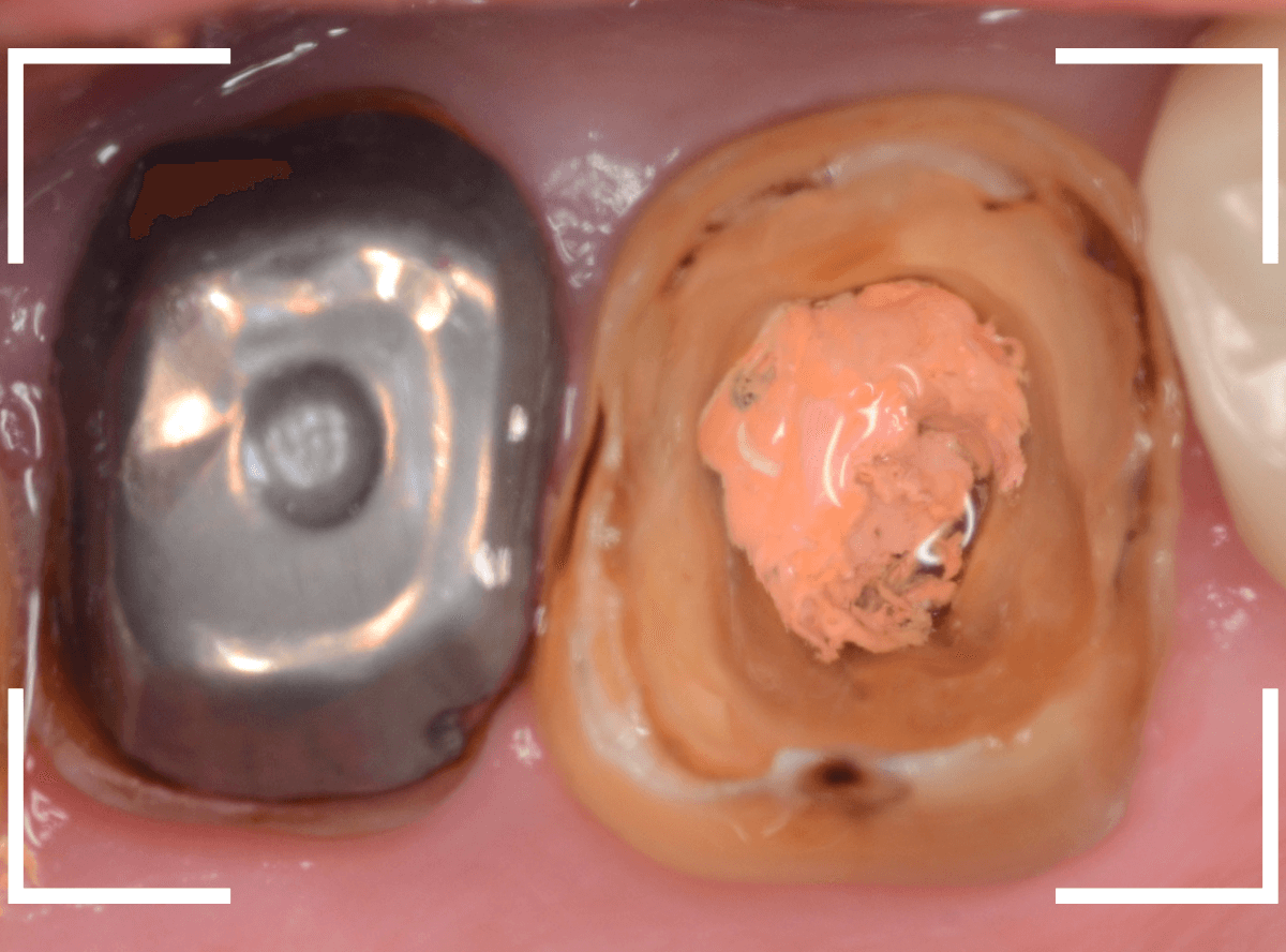 歯の土台の再治療3-6