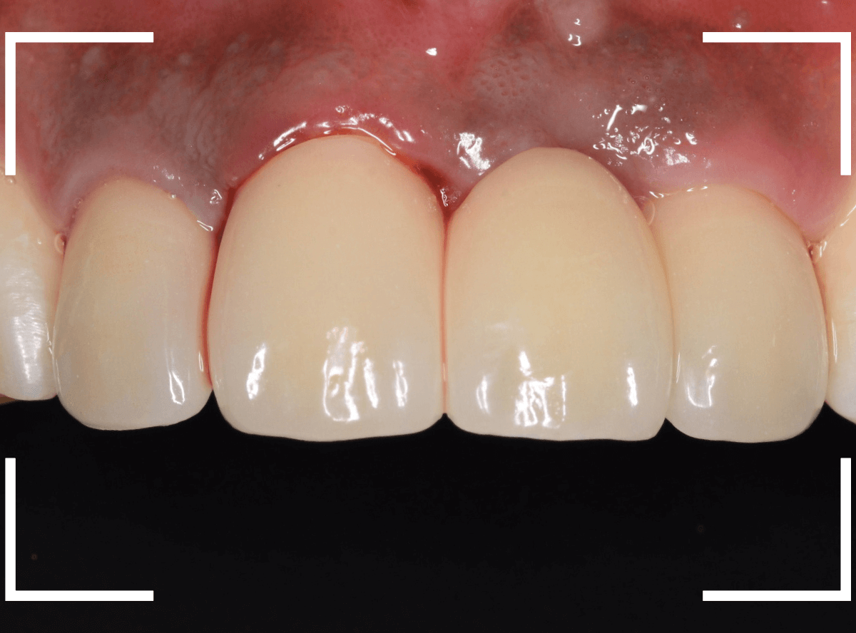 セラミック治療(前歯・クラウン)4-7
