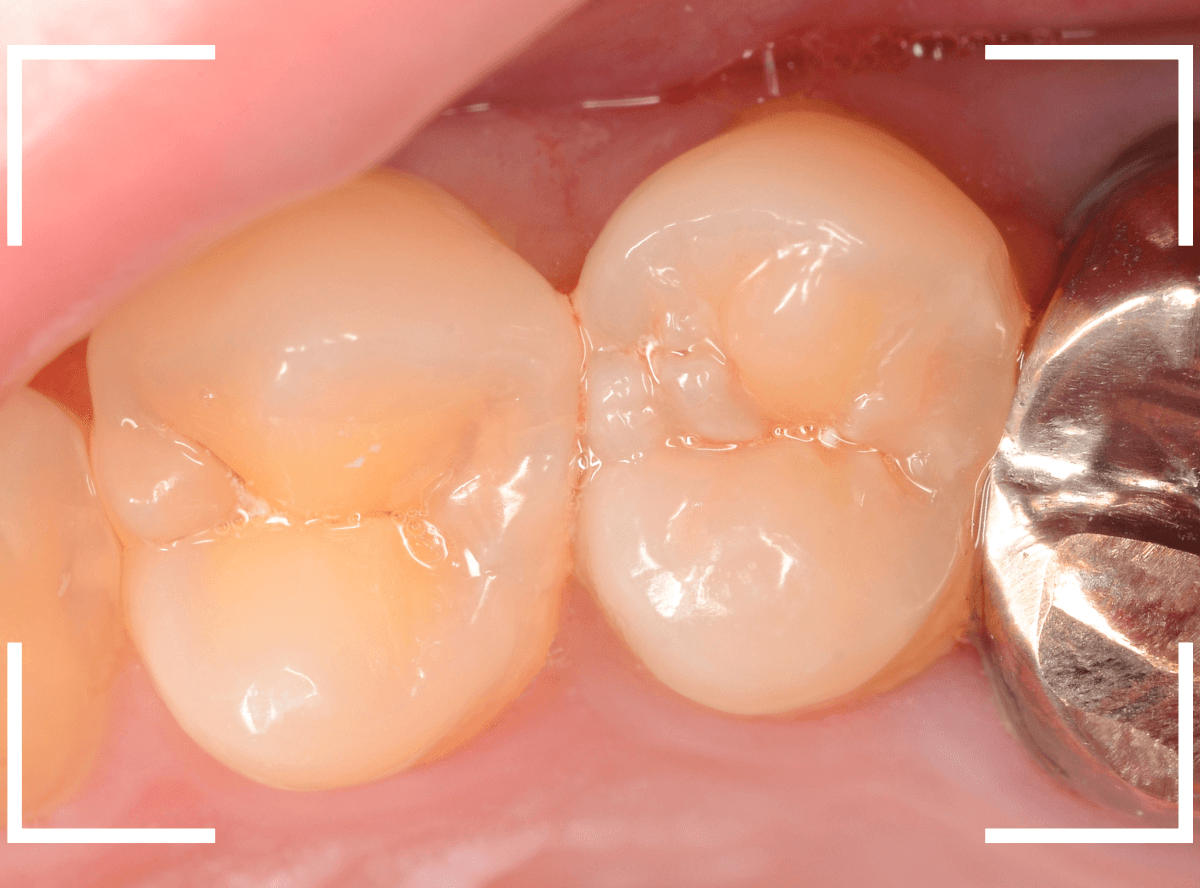 歯と歯の間の虫歯22-1