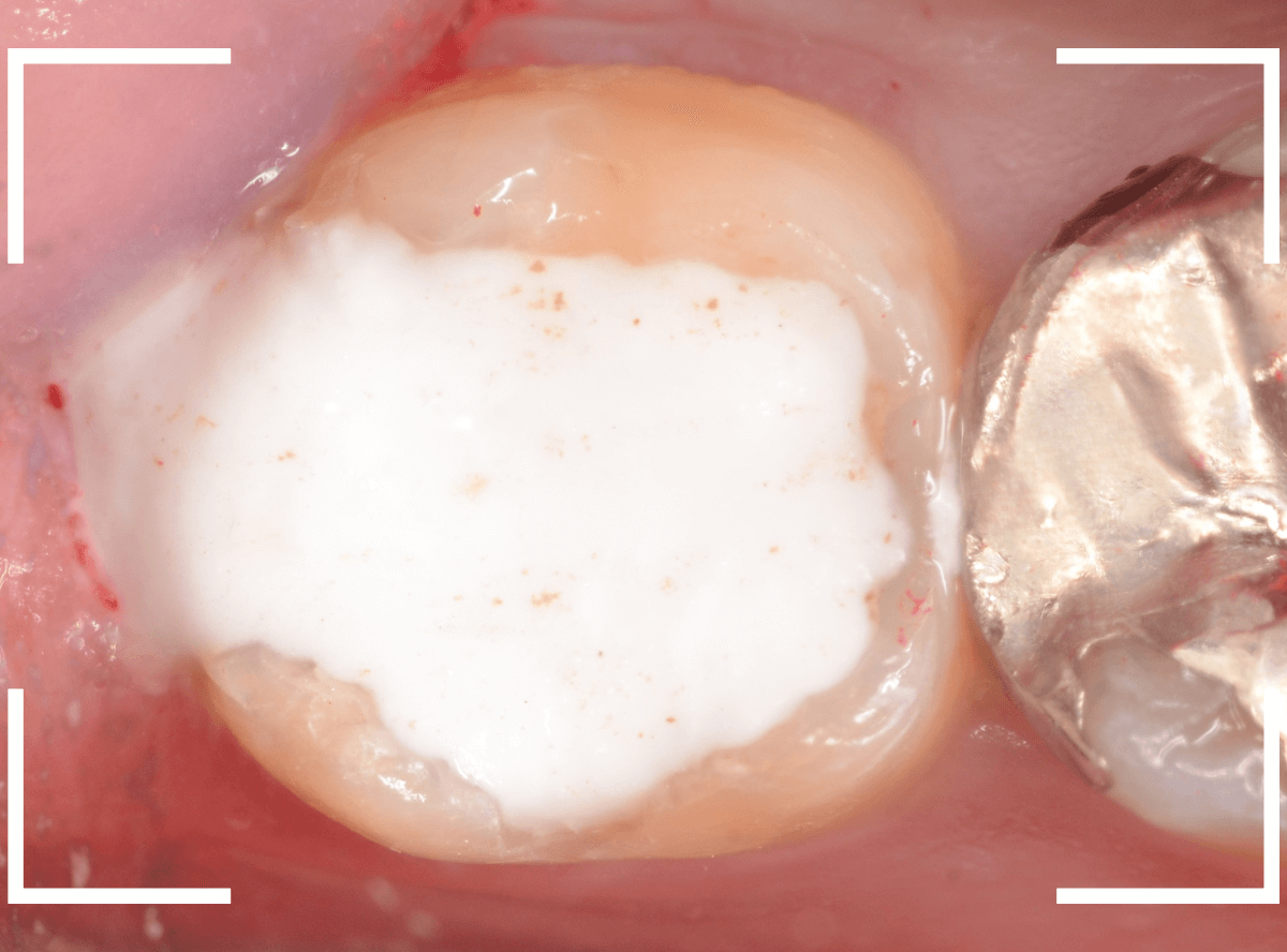 気づかないうちに深い虫歯13-7