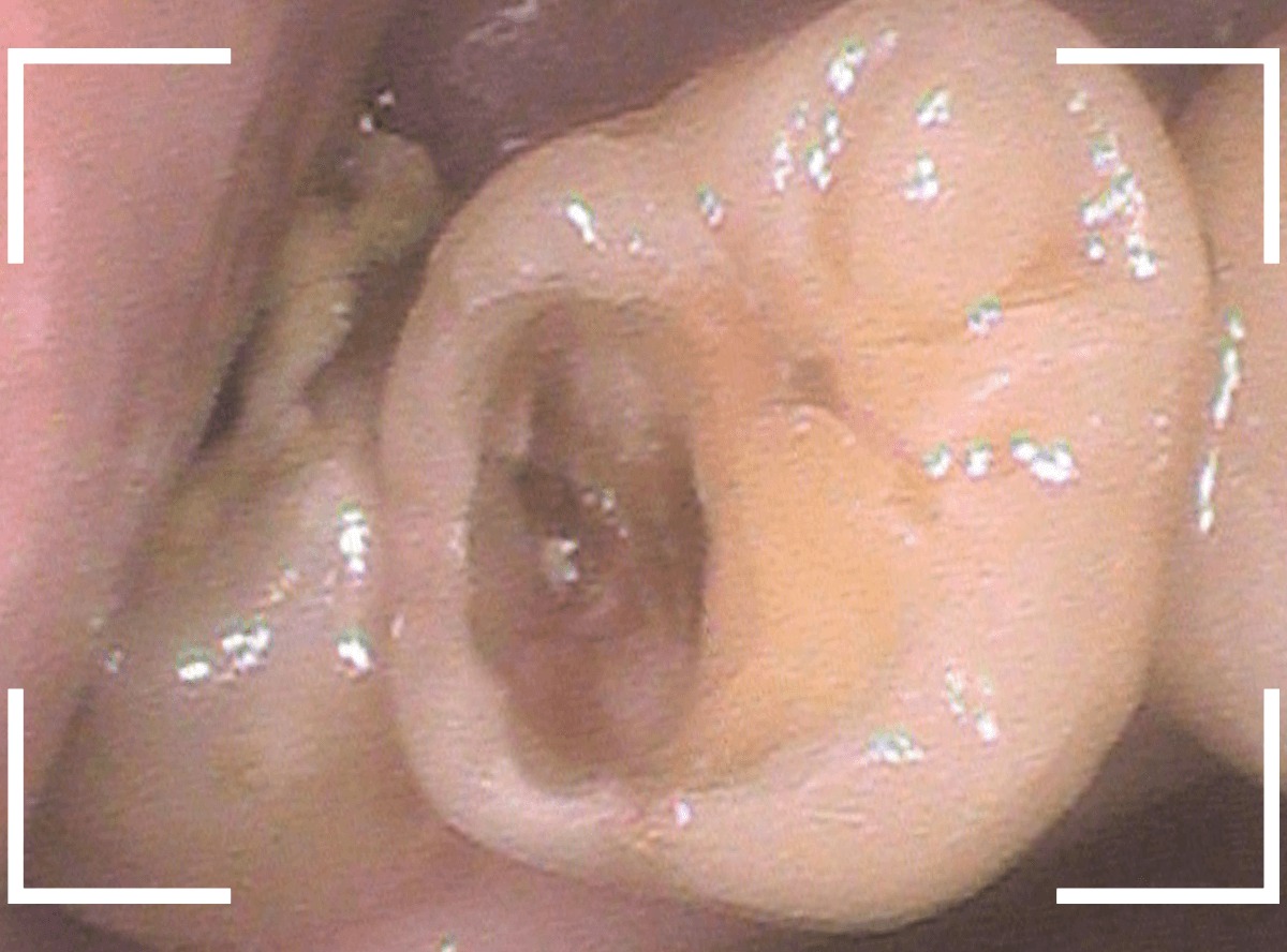 おやしらずの抜歯11-4