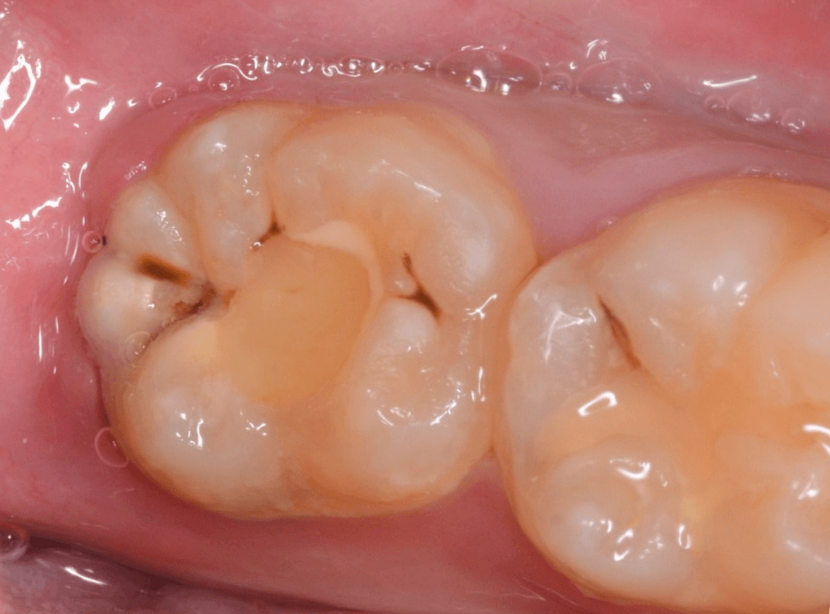 つめものの下の深い深い虫歯11-1