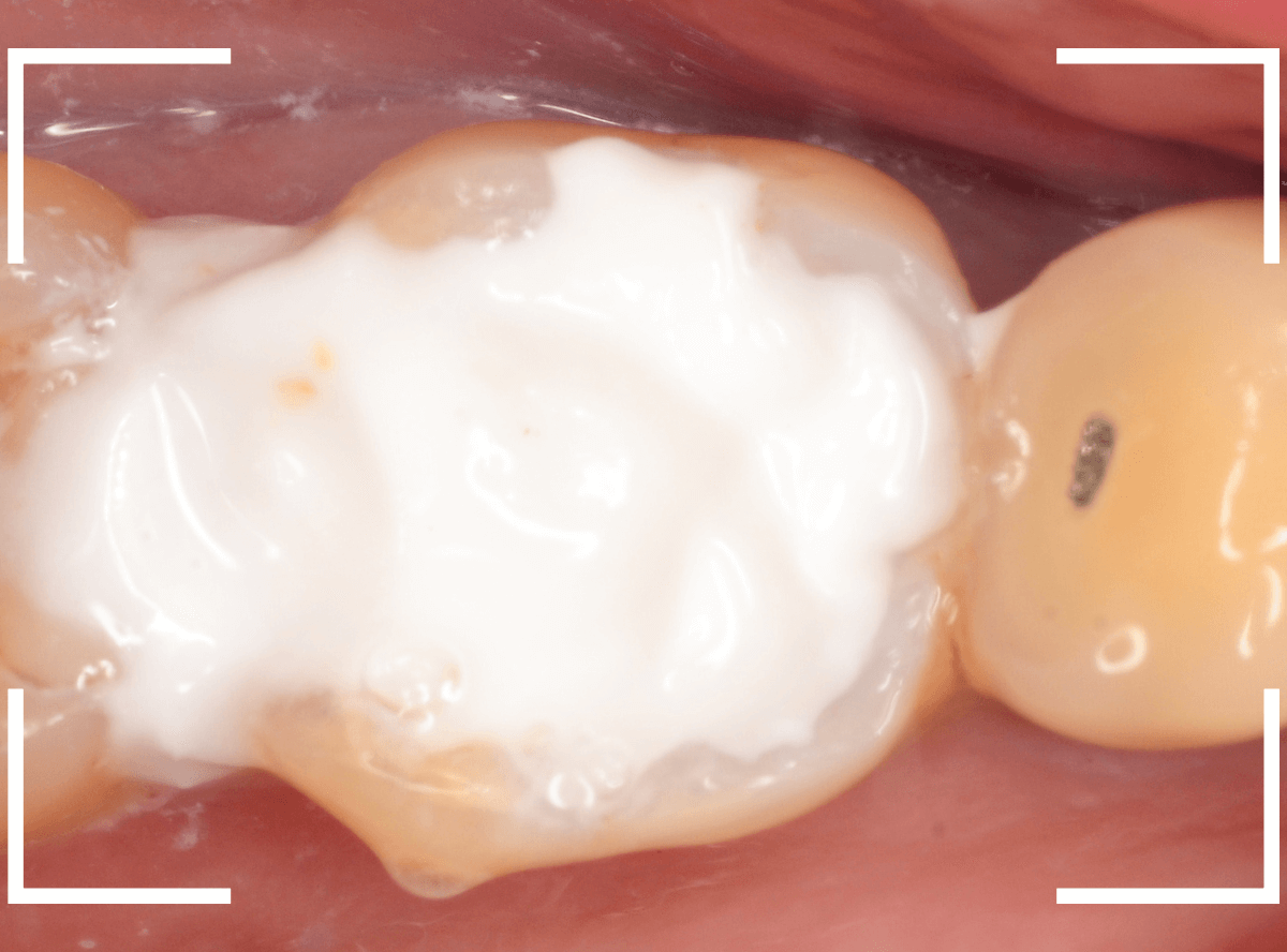 レントゲンでわかりづらい虫歯19-5