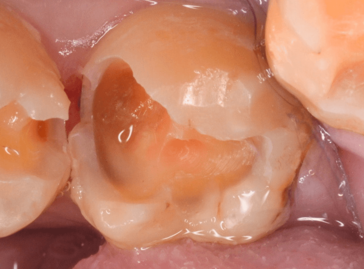 つめものの下の深い深い虫歯2-5