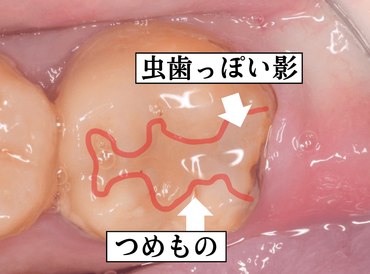 つめものの下の深い深い虫歯2-2