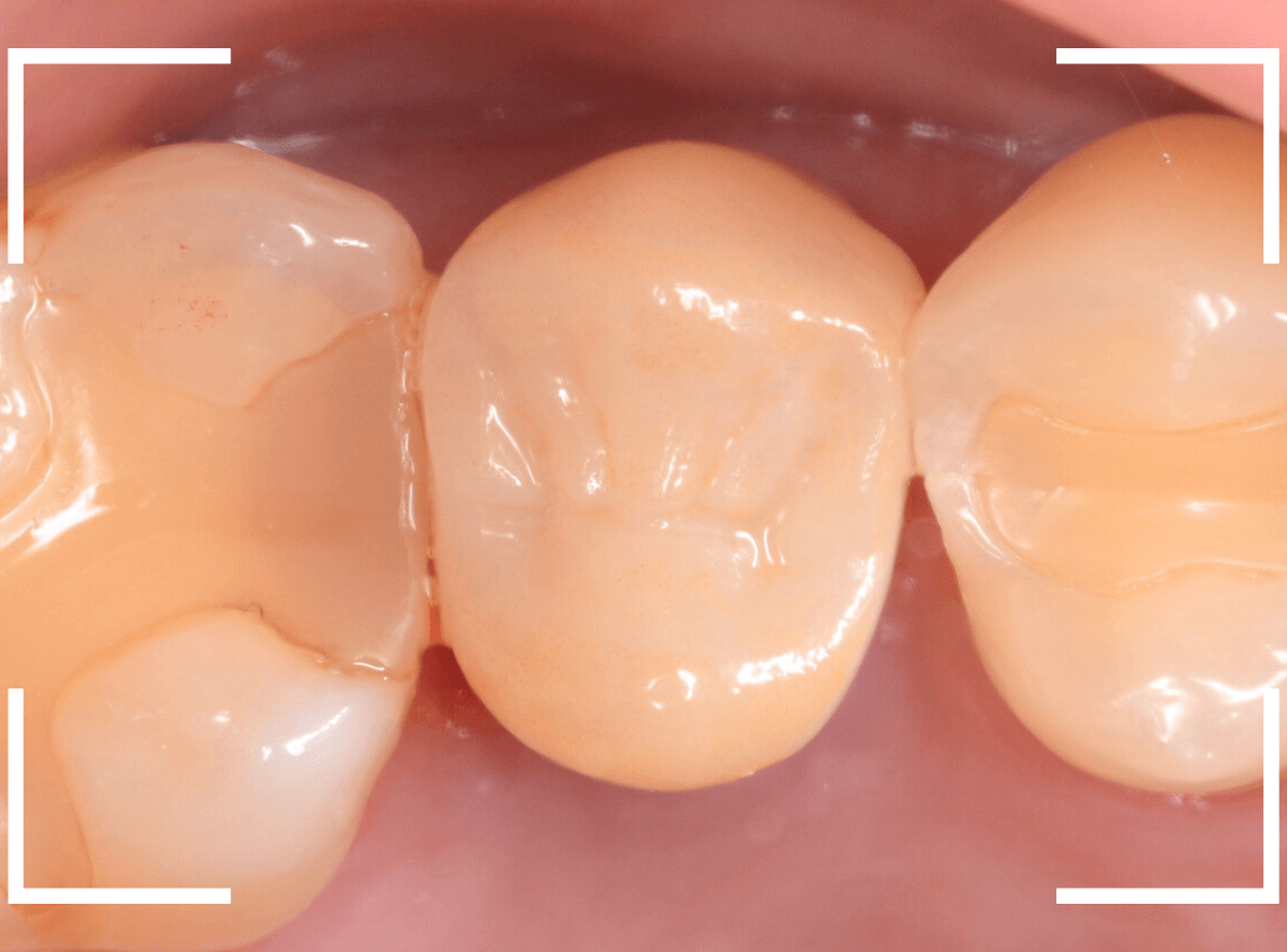 セラミック治療(クラウン・奥歯)8-8