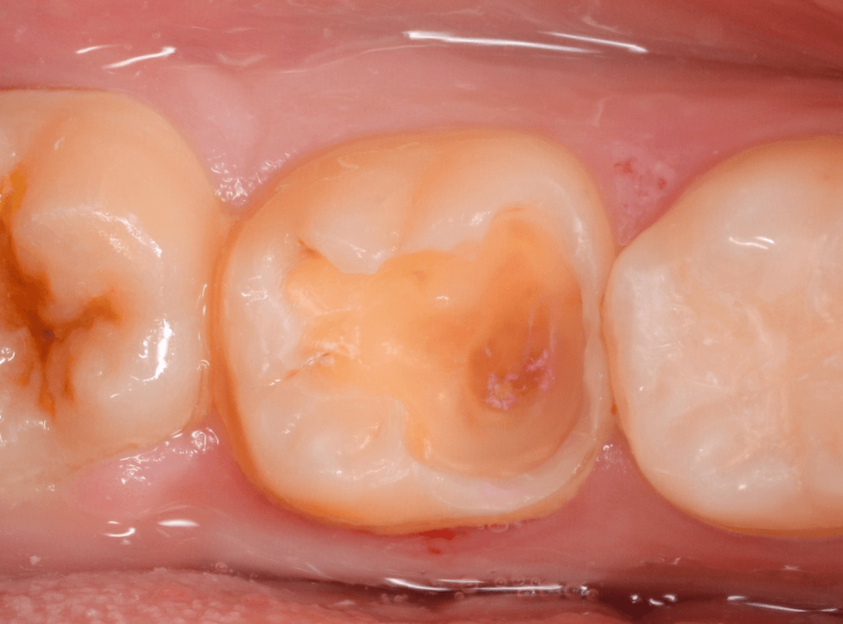 つめものの下の深い虫歯(画像)6-6