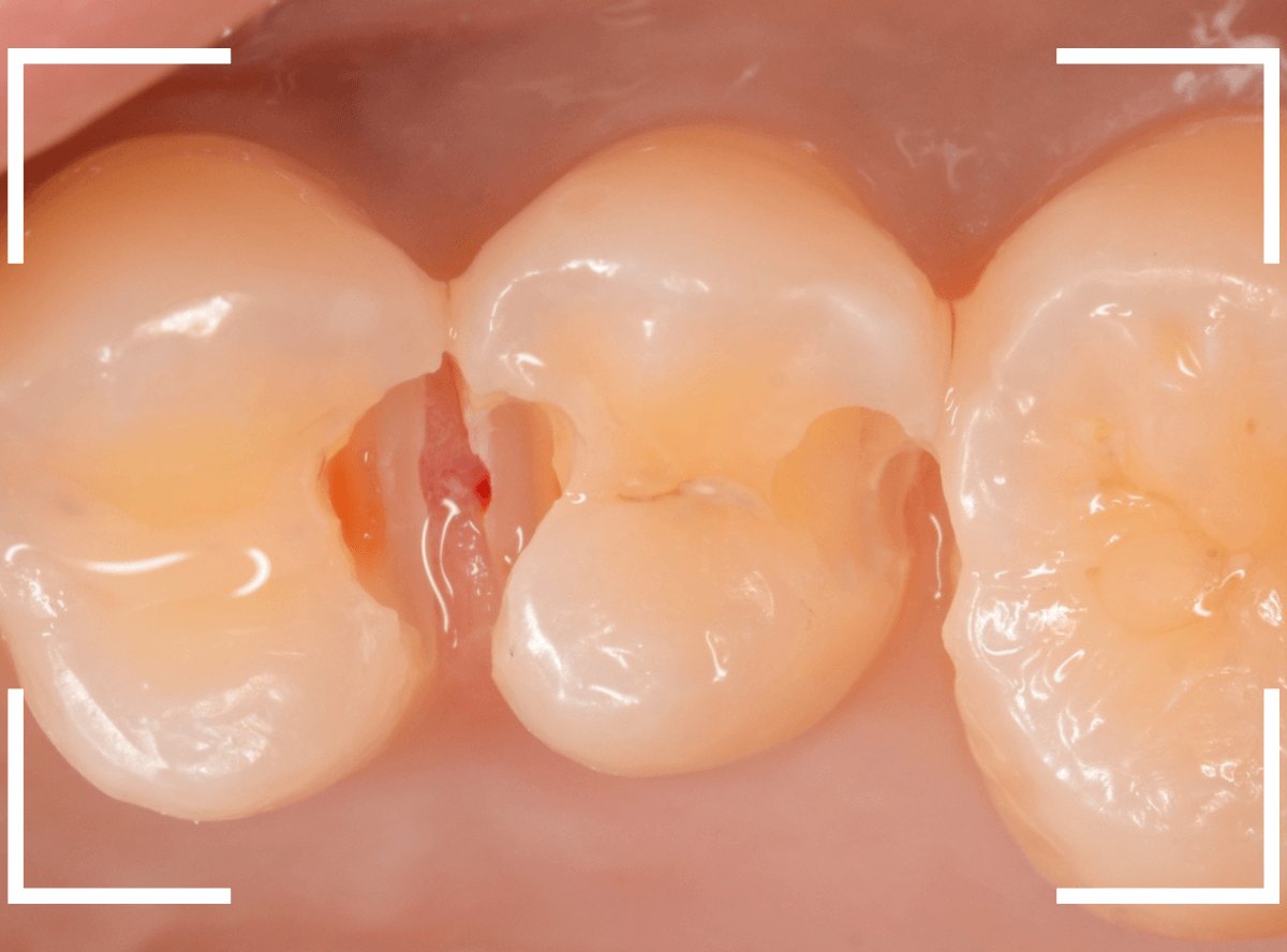 レントゲンでわかりづらい虫歯7-6
