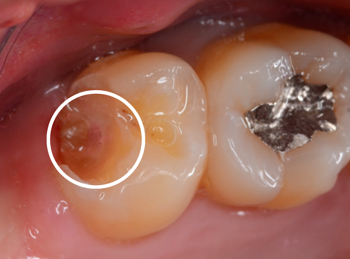 気づかないうちに深い虫歯1-7