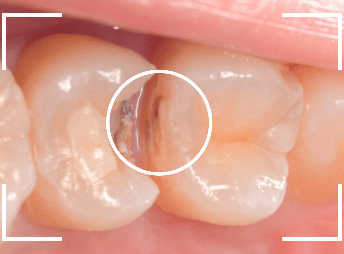 セラミック治療(インレー)27-4