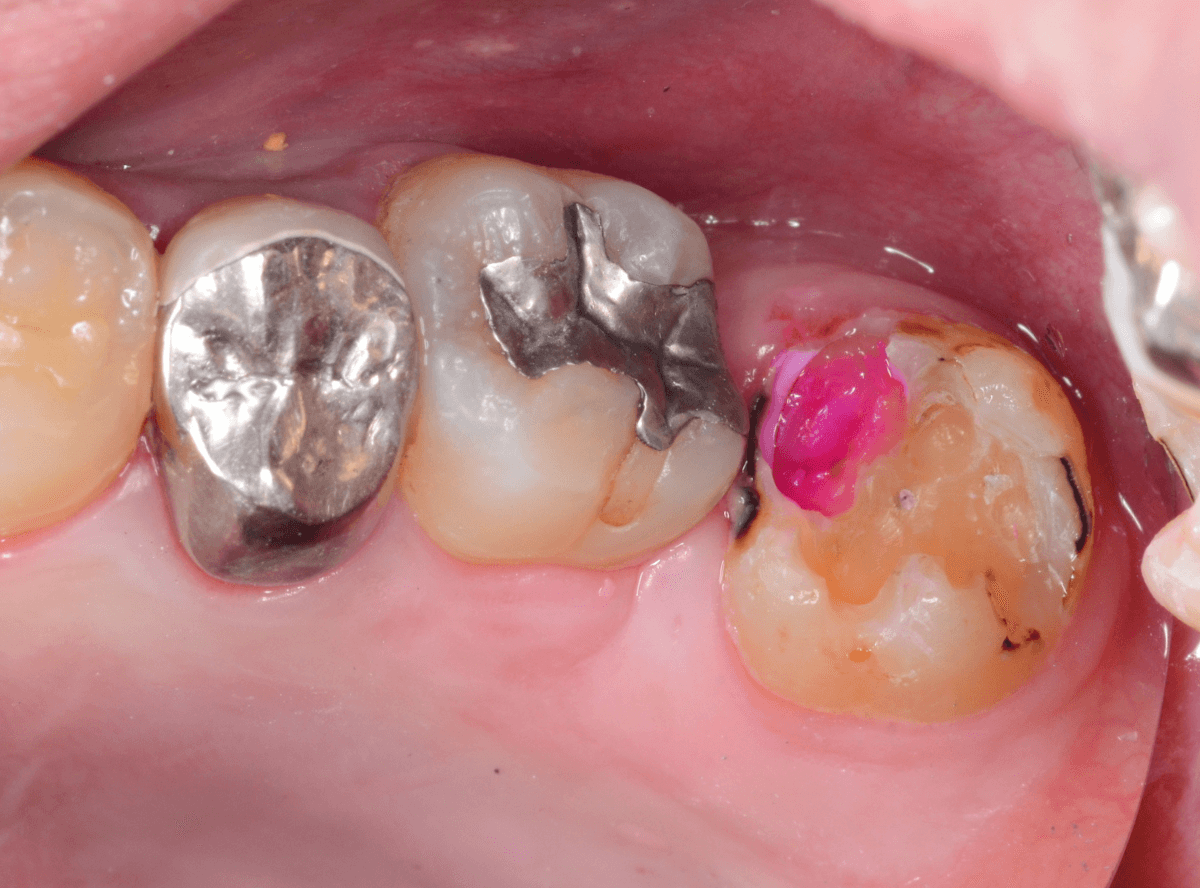 つめものの下の深い虫歯(画像)4-6