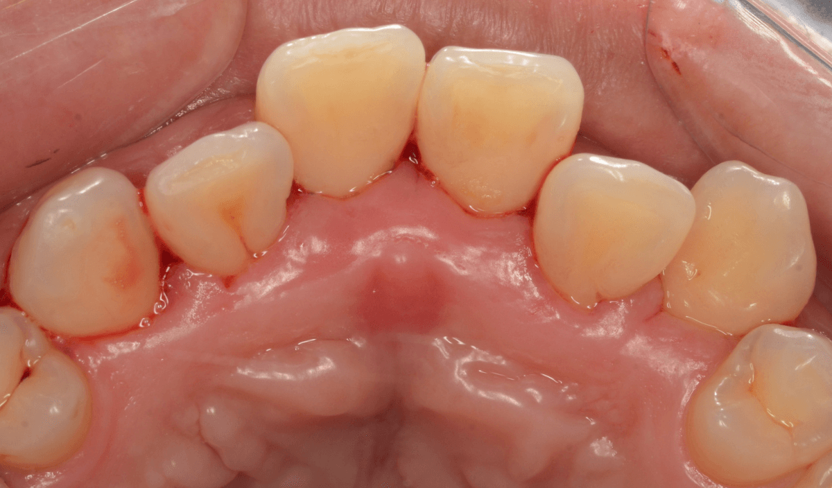 歯肉の中の歯石（歯肉縁下歯石）除去(画像）4-5