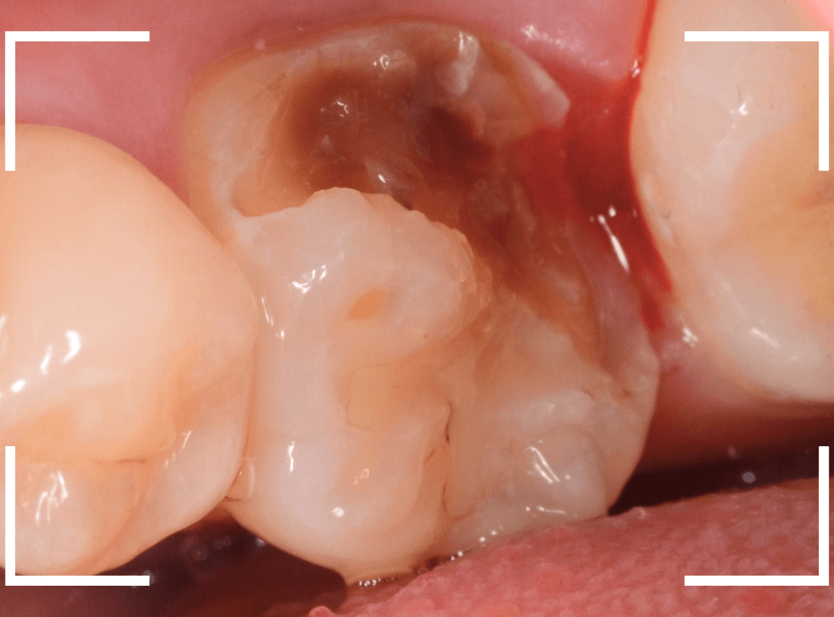 つめものの下の深い深い虫歯11-4