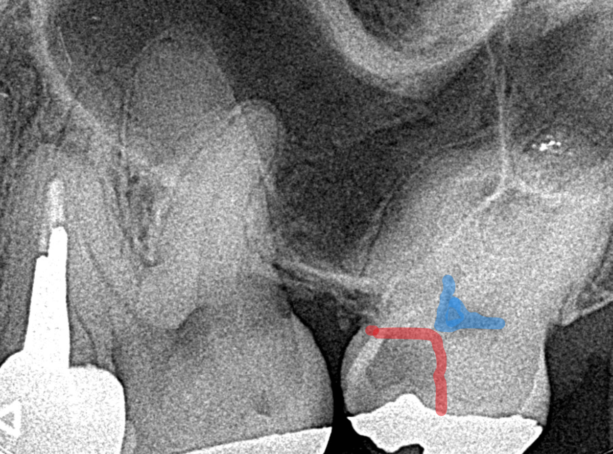 つめものの下の深い虫歯(画像)4-4