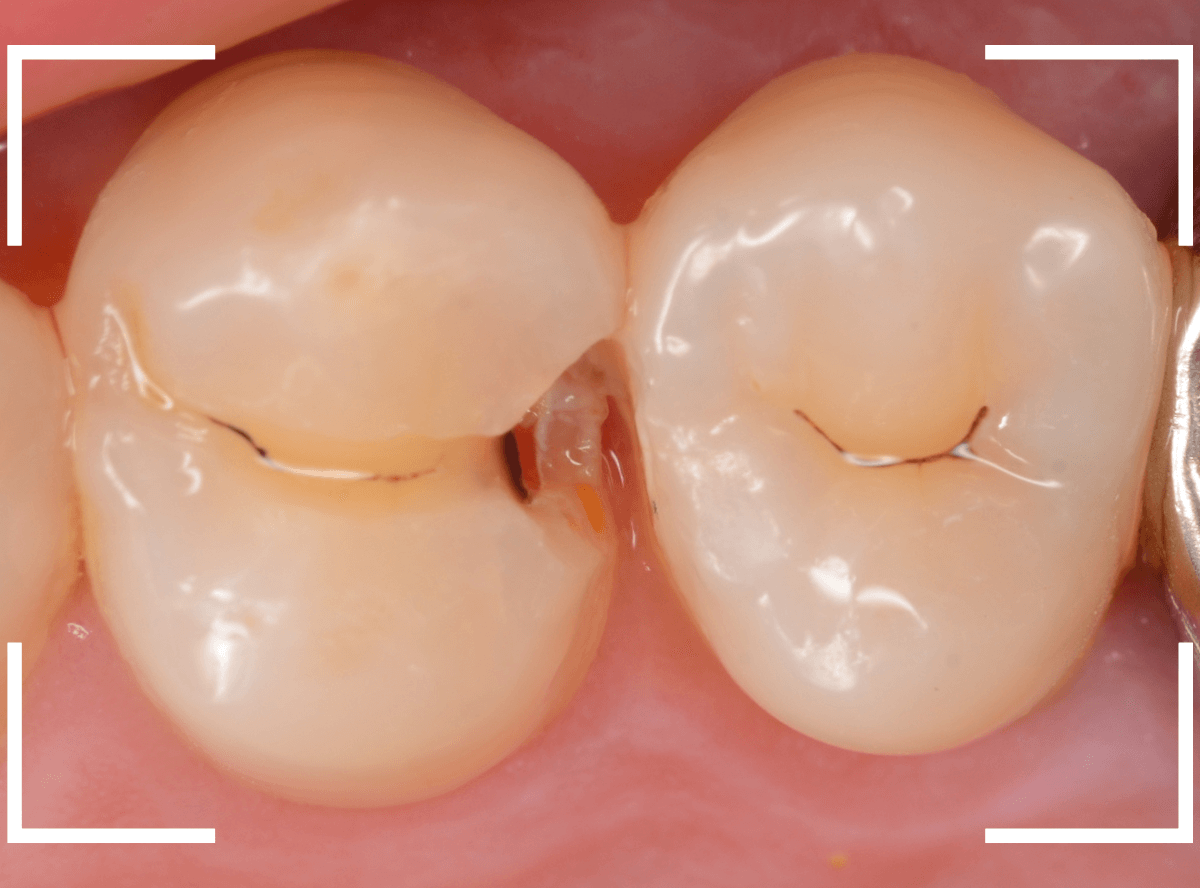 つめものの下の深い深い虫歯18-3