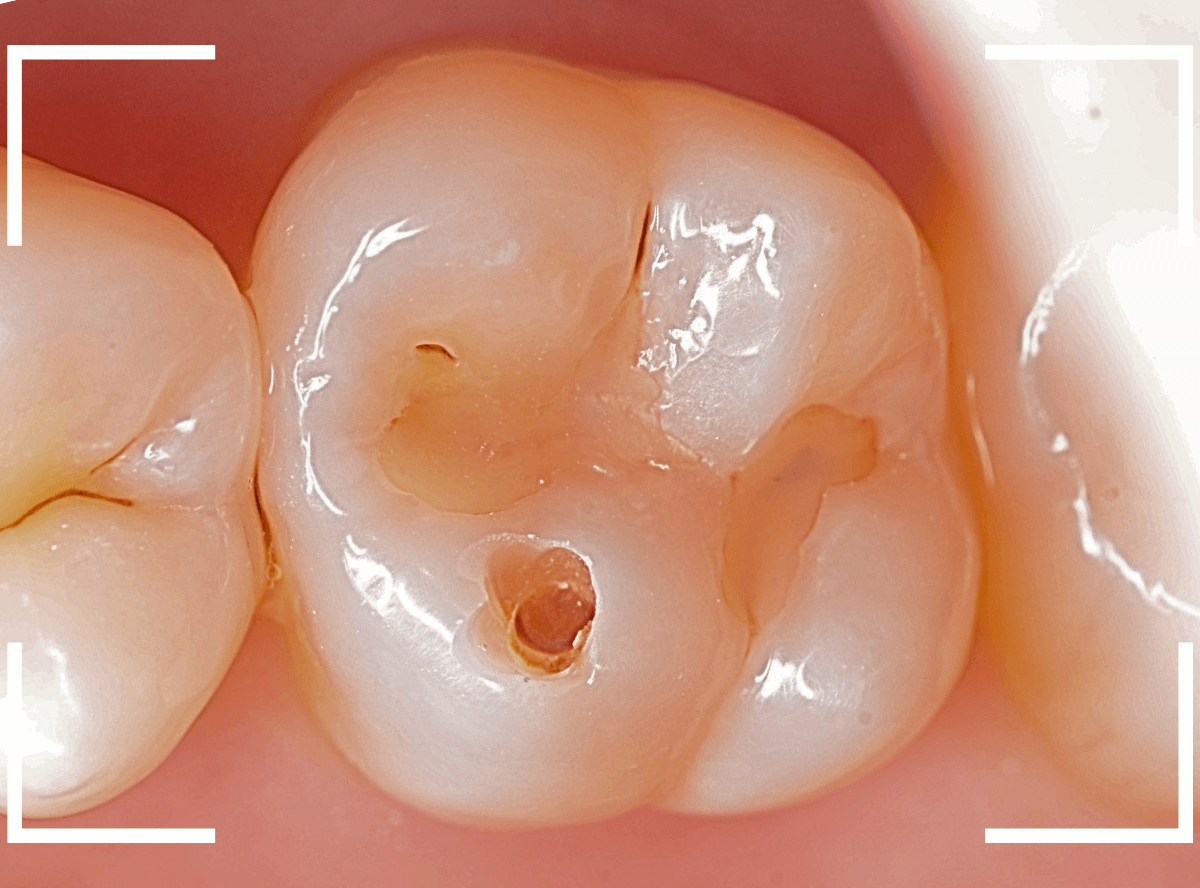 レントゲンでわかりづらい虫歯8-3